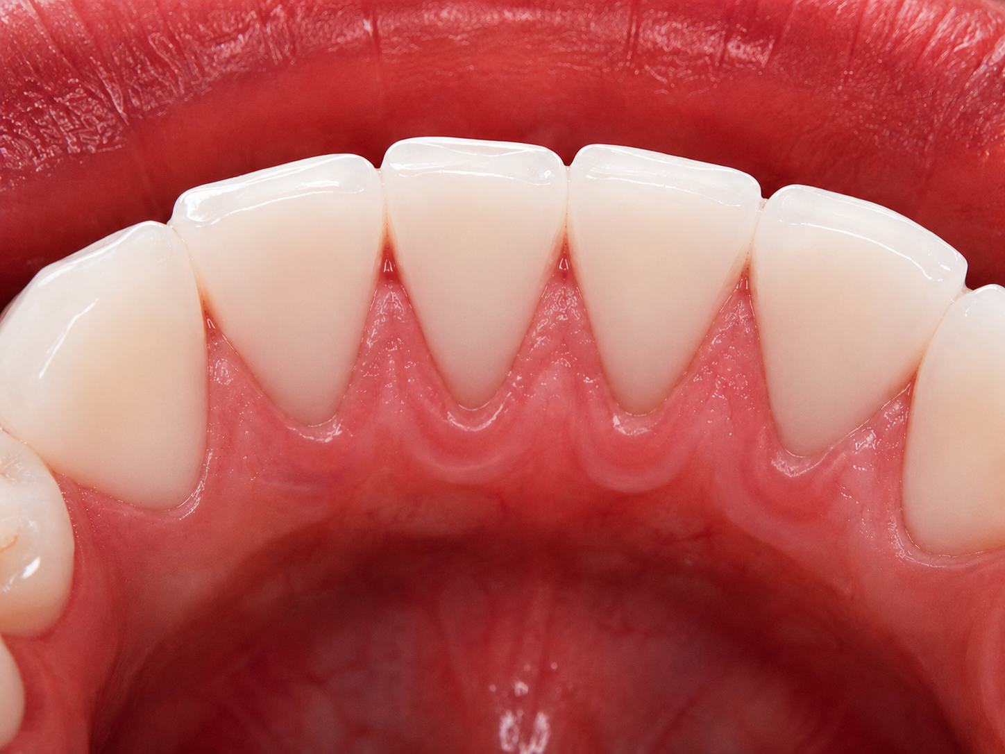 Dental Cleaning after treatment